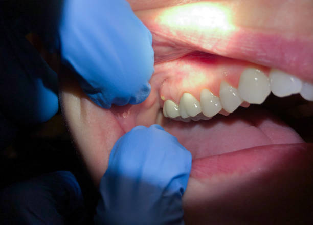 Best Emergency Dentist for Lost Fillings or Crowns in Tea, SD
